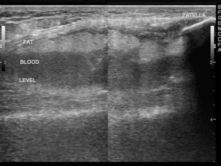 lipoma icd 10|lipoma of shoulder icd 10.